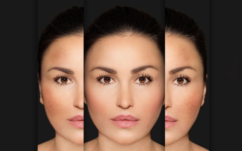 Sử dụng dịch vụ trị nám tại spa giúp khắc phục hiệu quả