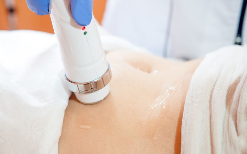 Vóc dáng có thể được cải thiện sau 5 - 6 buổi liệu trình giảm béo bằng công nghệ